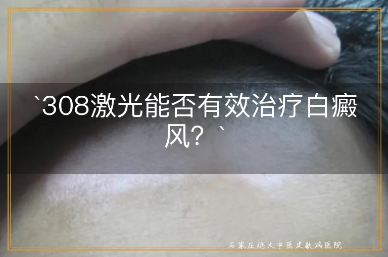 `308激光能否有效治疗白癜风？`