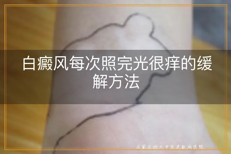 白癜风每次照完光很痒的缓解方法