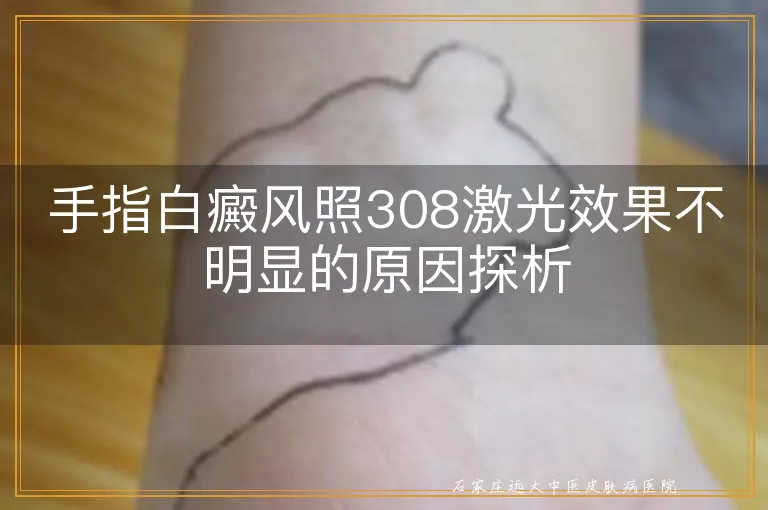 手指白癜风照308激光效果不明显的原因探析