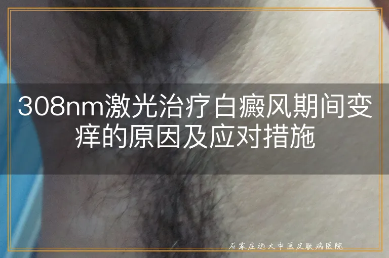 308nm激光治疗白癜风期间变痒的原因及应对措施