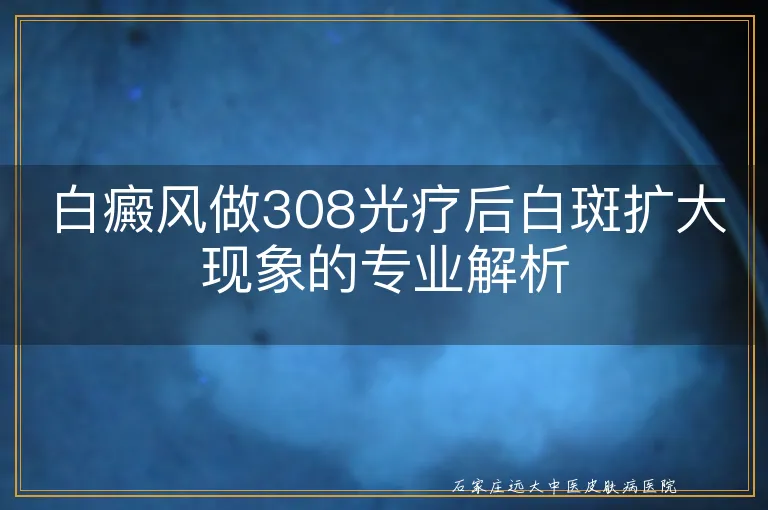 白癜风做308光疗后白斑扩大现象的专业解析