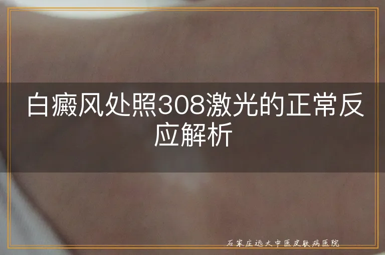 白癜风处照308激光的正常反应解析