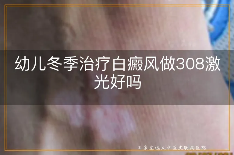 幼儿冬季治疗白癜风做308激光好吗