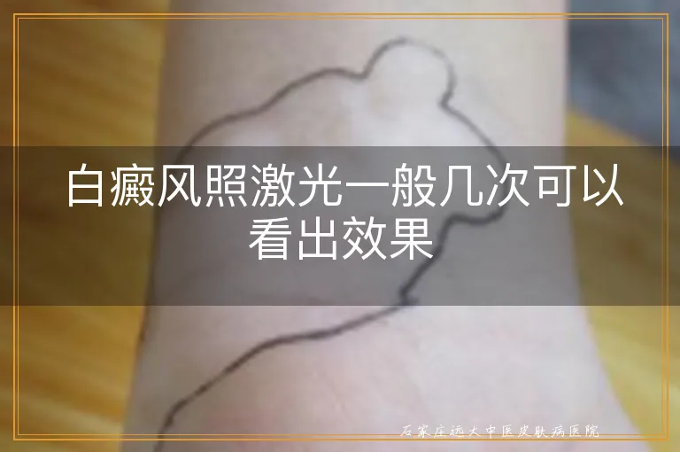 白癜风照激光一般几次可以看出效果