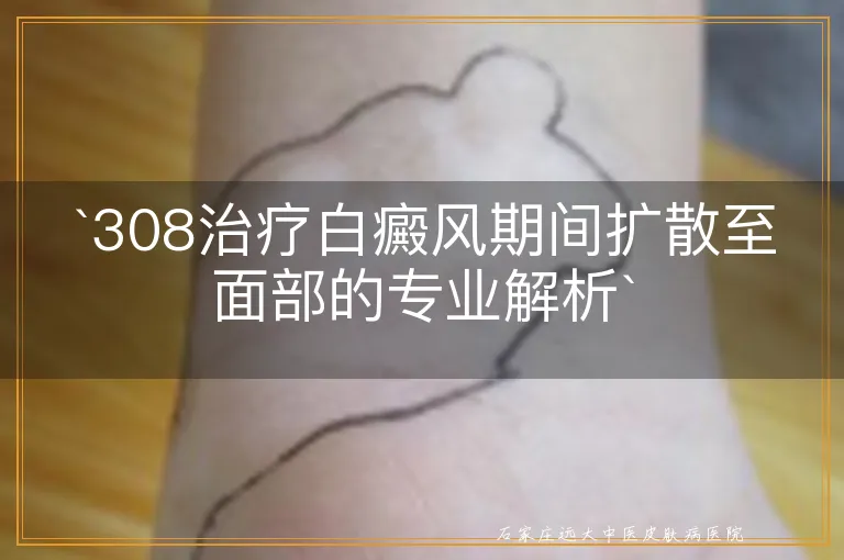 `308治疗白癜风期间扩散至面部的专业解析`