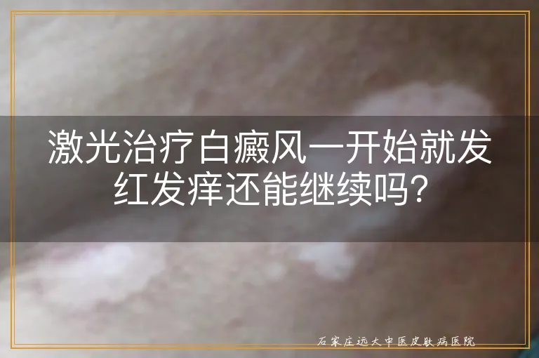 激光治疗白癜风一开始就发红发痒还能继续吗？