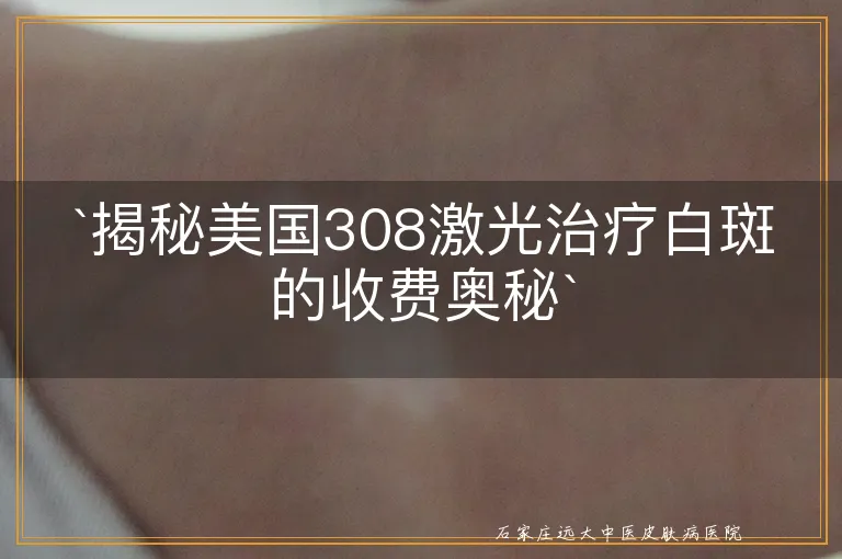 `揭秘美国308激光治疗白斑的收费奥秘`