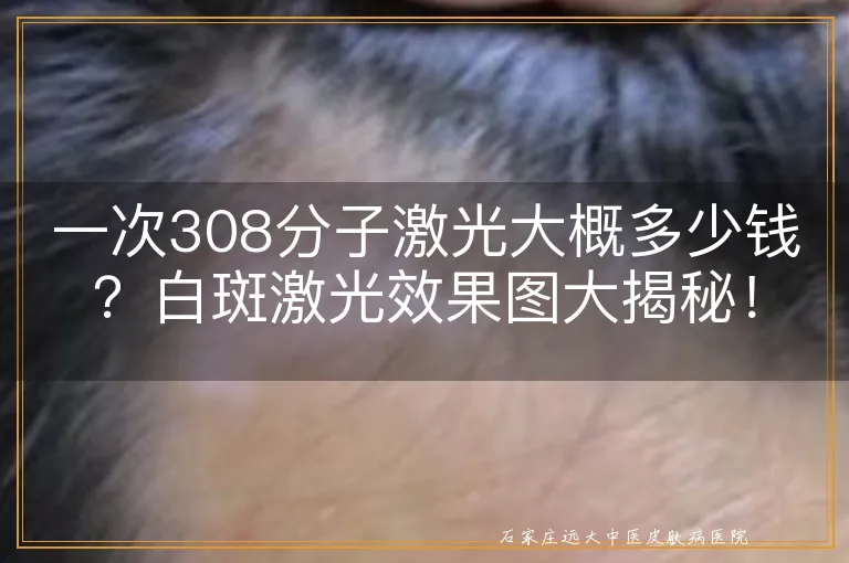 一次308分子激光大概多少钱？白斑激光效果图大揭秘！