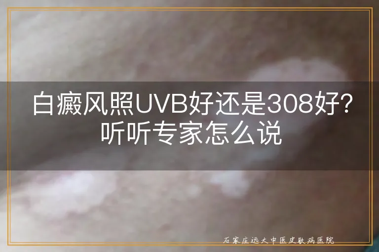 白癜风照UVB好还是308好？听听专家怎么说