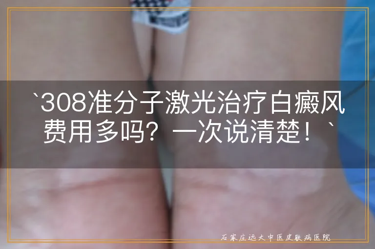 `308准分子激光治疗白癜风费用多吗？一次说清楚！`