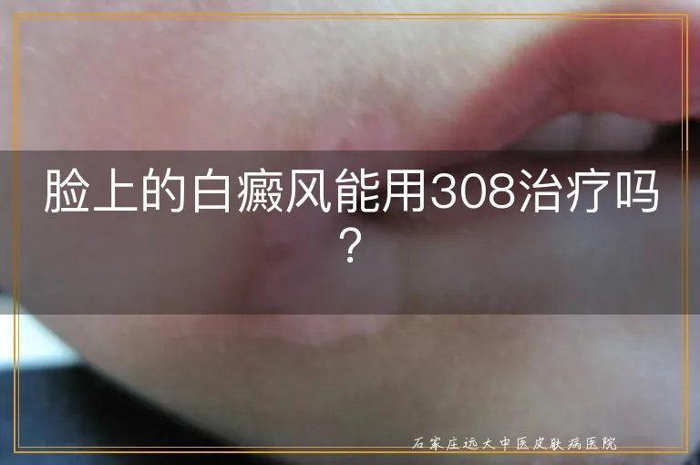 脸上的白癜风能用308治疗吗？