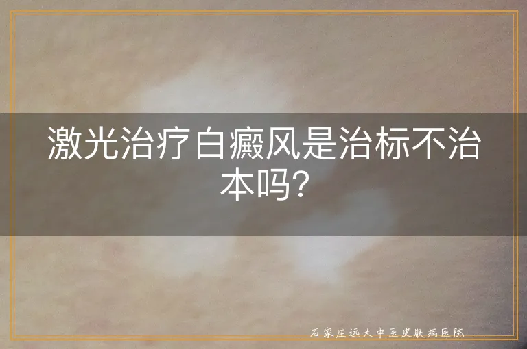 激光治疗白癜风是治标不治本吗？