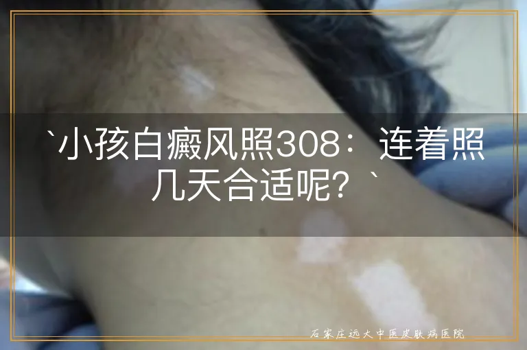 `小孩白癜风照308：连着照几天合适呢？`