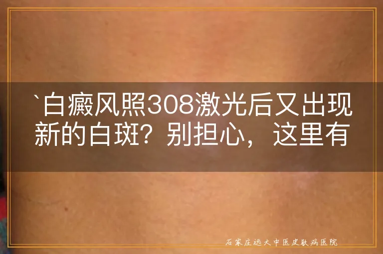 白癜风照308激光后又出现新的白斑？别担心，这里有解答