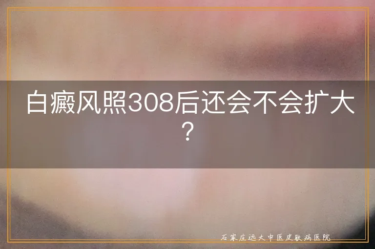 白癜风照308后还会不会扩大？