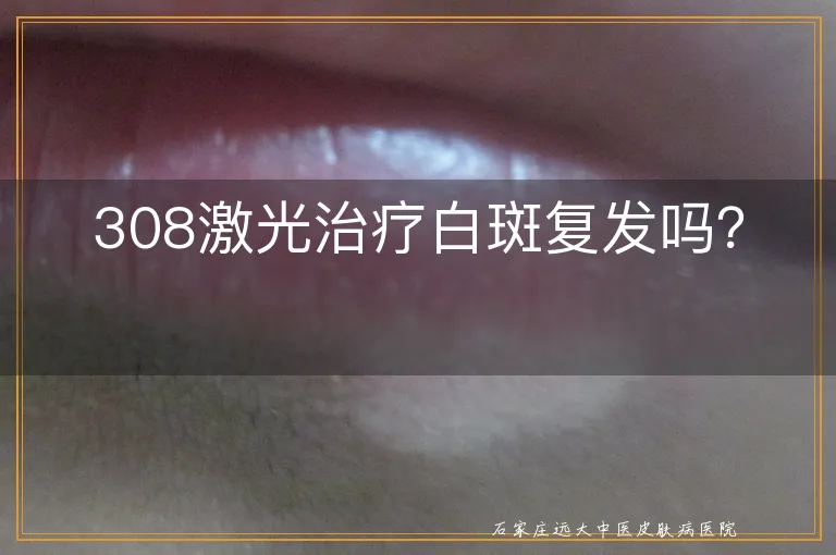 308激光治疗白斑复发吗？