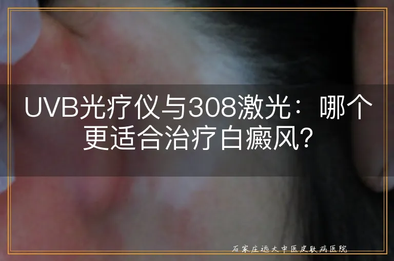 UVB光疗仪与308激光：哪个更适合治疗白癜风？