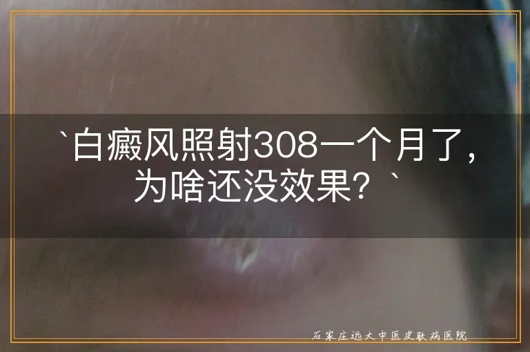 `白癜风照射308一个月了，为啥还没效果？`