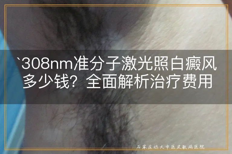 308nm准分子激光照白癜风多少钱？全面解析治疗费用