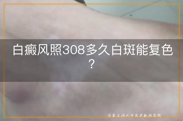 白癜风照308多久白斑能复色？