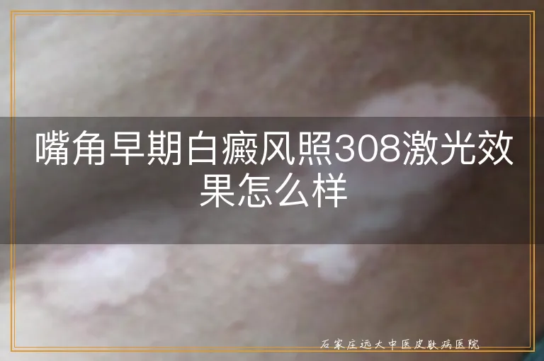 嘴角早期白癜风照308激光效果怎么样