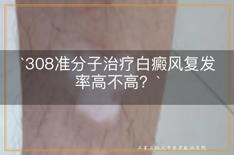 308准分子治疗白癜风复发率高不高？