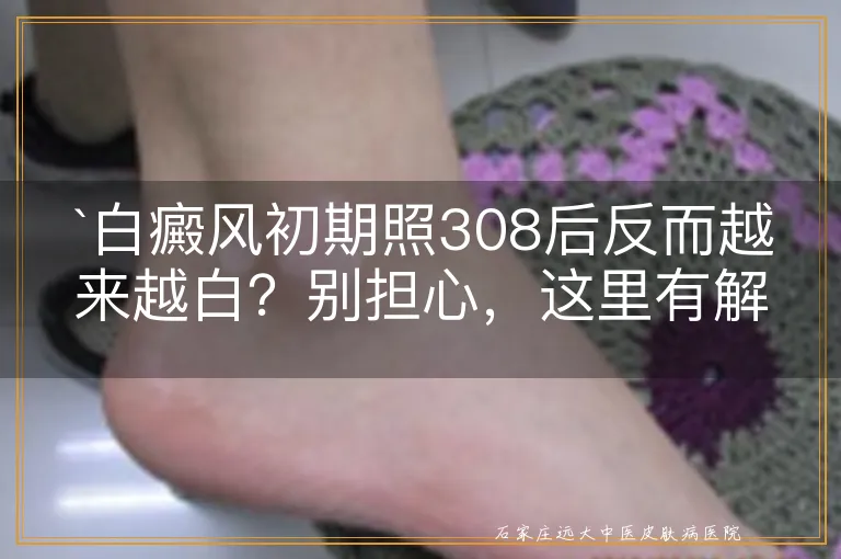 `白癜风初期照308后反而越来越白？别担心，这里有解答`