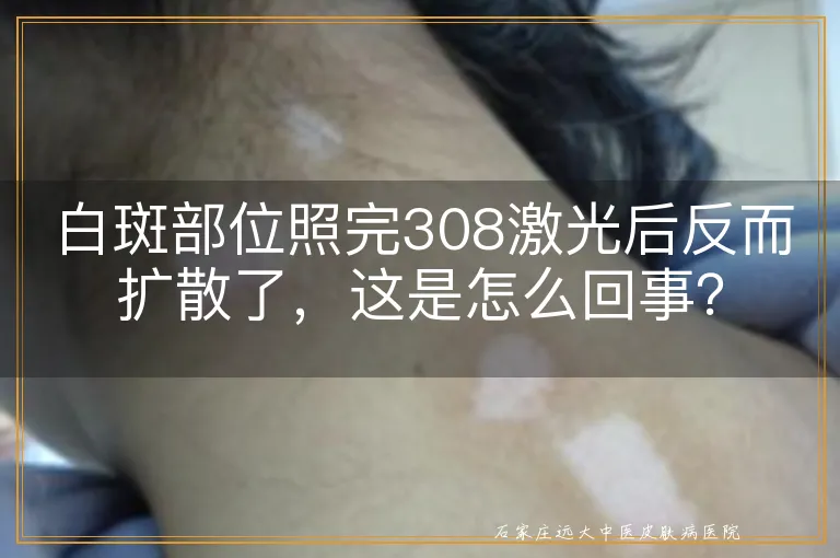 白斑部位照完308激光后反而扩散了，这是怎么回事？