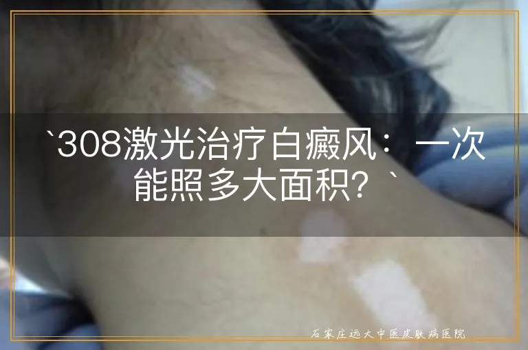 `308激光治疗白癜风：一次能照多大面积？`