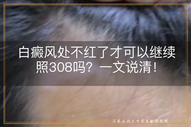 白癜风处不红了才可以继续照308吗？一文说清！