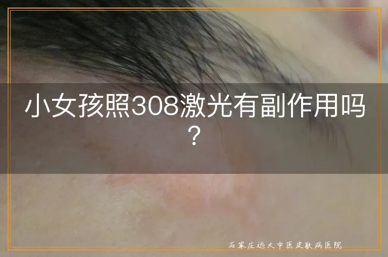 小女孩照308激光有副作用吗？