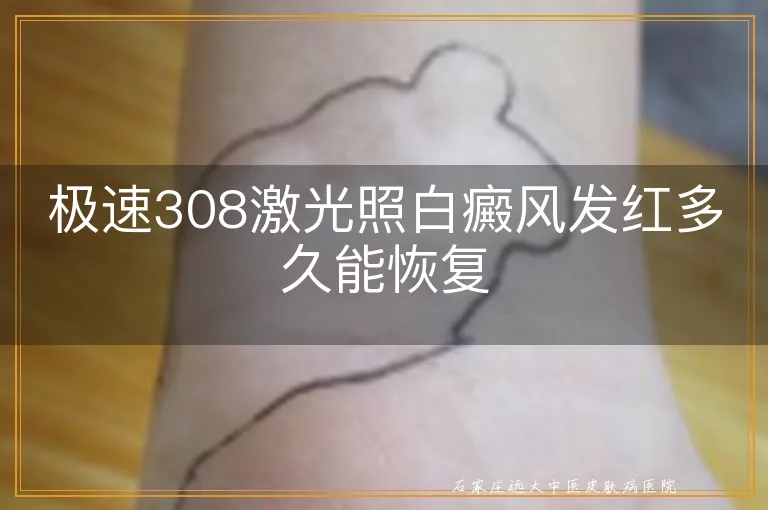 极速308激光照白癜风发红多久能恢复