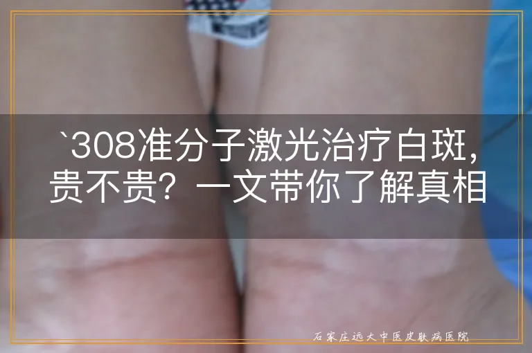 `308准分子激光治疗白斑，贵不贵？一文带你了解真相`