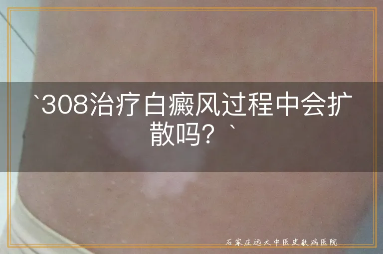 `308治疗白癜风过程中会扩散吗？`