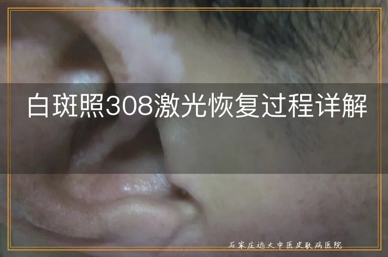 白斑照308激光恢复过程详解