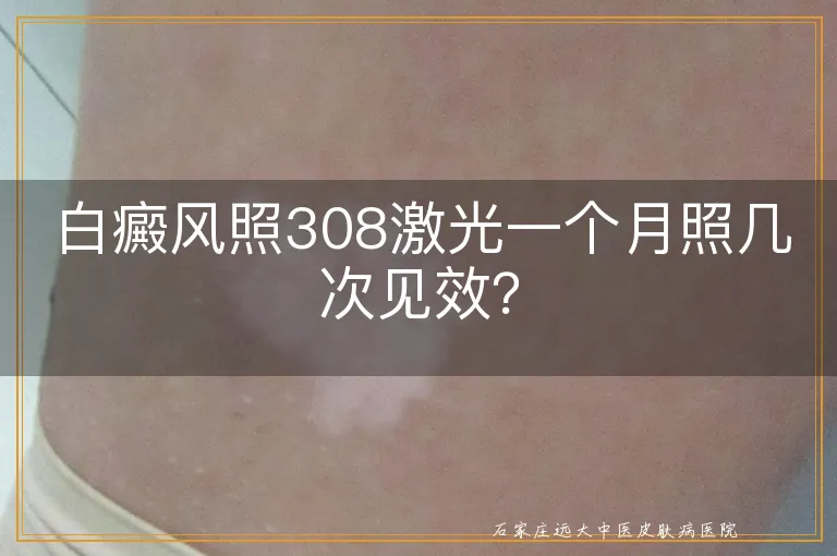 白癜风照308激光一个月照几次见效？