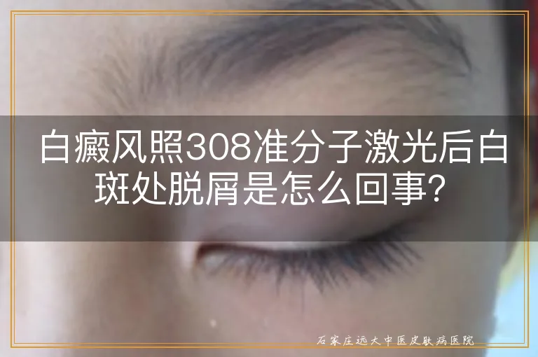 白癜风照308准分子激光后白斑处脱屑是怎么回事？