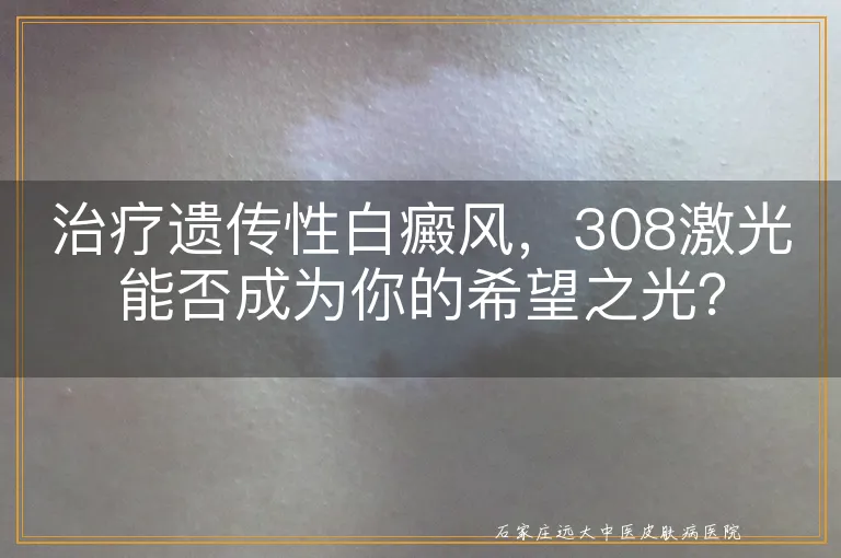 治疗遗传性白癜风，308激光能否成为你的希望之光？