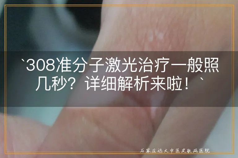 `308准分子激光治疗一般照几秒？详细解析来啦！`