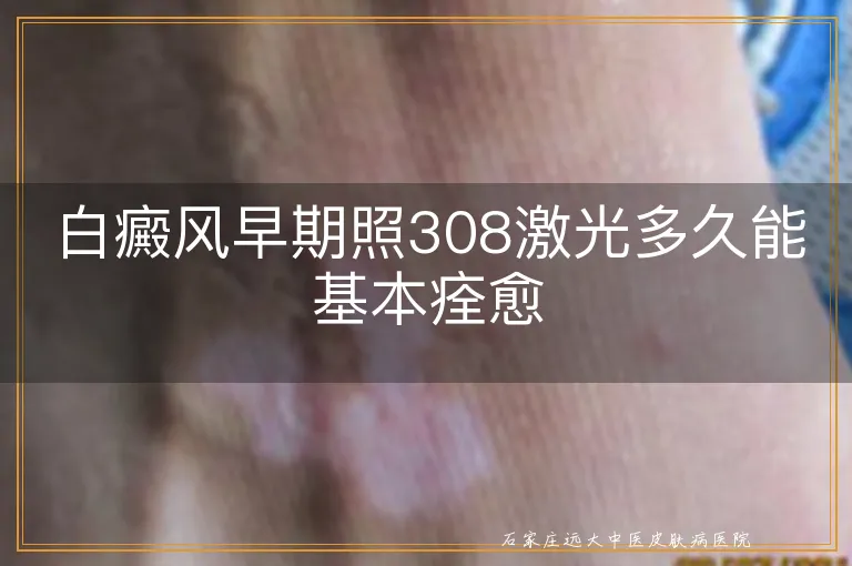 白癜风早期照308激光多久能基本痊愈