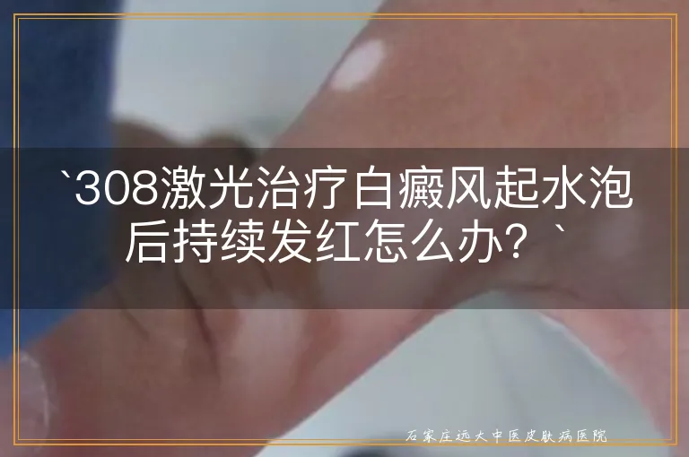 `308激光治疗白癜风起水泡后持续发红怎么办？`