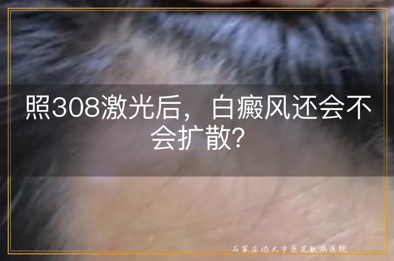 照308激光后，白癜风还会不会扩散？