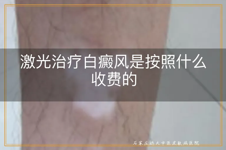 激光治疗白癜风是按照什么收费的