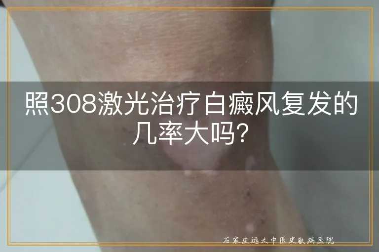 照308激光治疗白癜风复发的几率大吗？