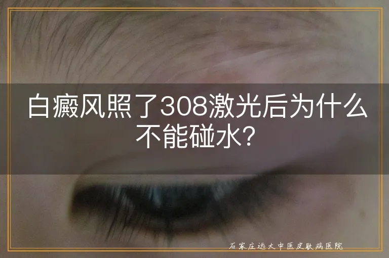 白癜风照了308激光后为什么不能碰水？