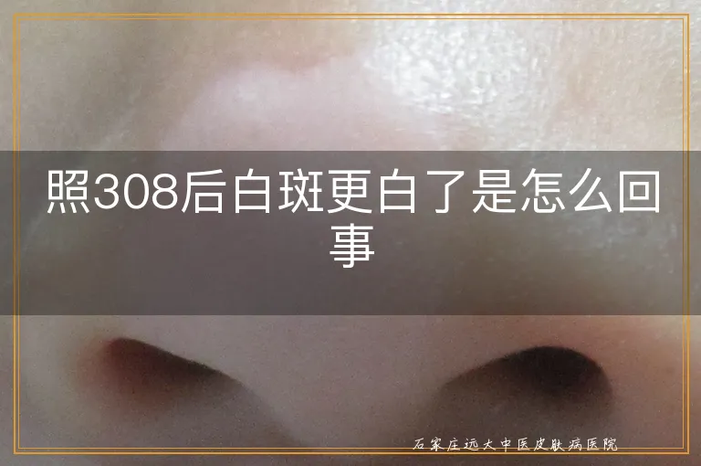 照308后白斑更白了是怎么回事