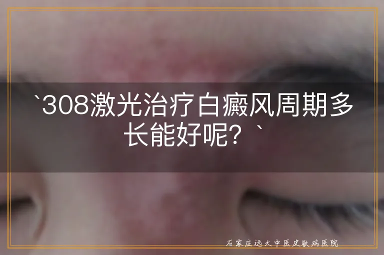 `308激光治疗白癜风周期多长能好呢？`