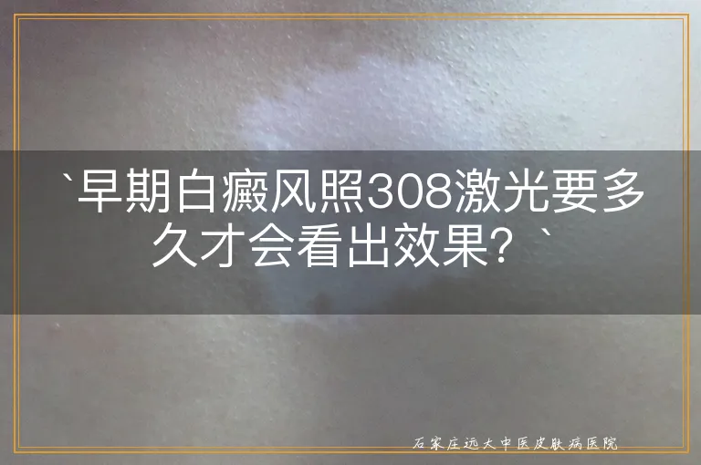 `早期白癜风照308激光要多久才会看出效果？`