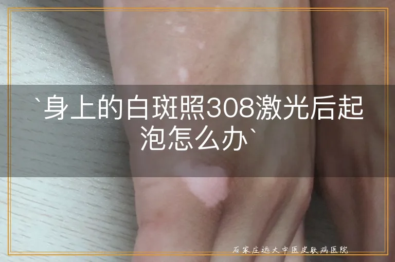 `身上的白斑照308激光后起泡怎么办`