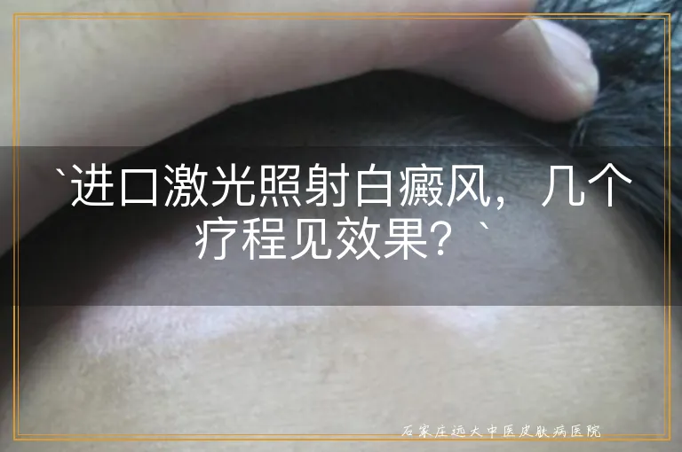 `进口激光照射白癜风，几个疗程见效果？`